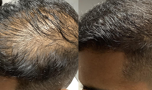 mesotherapy hair restoration before after mississauga oakville